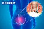 Charger l'image dans la galerie, HEMOCALM™ Crème Apaisante pour Hémorroïdes, Démangeaisons , Brûlures &amp; Inconfort Anal
