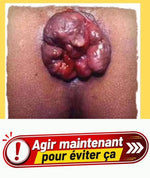 Charger l'image dans la galerie, HEMOCALM™ Crème Apaisante pour Hémorroïdes, Démangeaisons , Brûlures &amp; Inconfort Anal
