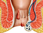 Charger l'image dans la galerie, HEMOCALM™ Crème Apaisante pour Hémorroïdes, Démangeaisons , Brûlures &amp; Inconfort Anal
